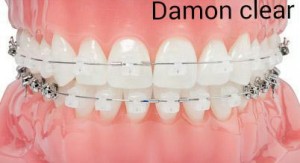 ��������� �������� Damon Clear